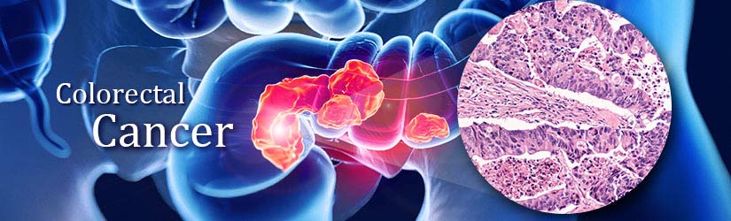 Colorectal Cancer Tumor Markers