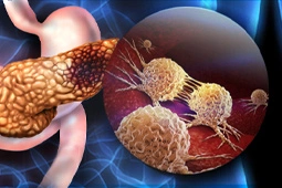 Article Alert: Cellular Interactions in the Tumor Microenvironment Drive Pancreatic Malignancies