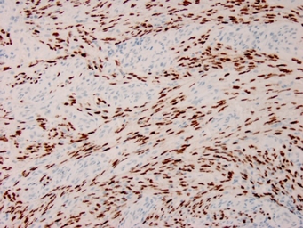 Anti-KSHV ORF73 antibody [HHV8/3633R] used in IHC (Paraffin sections) (IHC-P). GTX02772