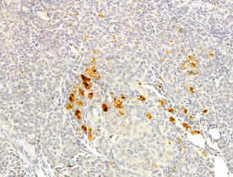 Anti-p70 S6K (phospho Thr389/Thr412) antibody used in IHC (Paraffin sections) (IHC-P). GTX05173