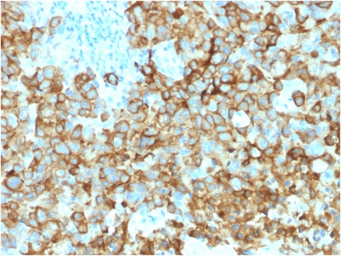 Anti-Melanoma gp100 antibody [PMEL/2039] used in IHC (Paraffin sections) (IHC-P). GTX17783