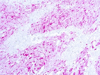 Anti-S100 antibody (ready-to-use) used in IHC (Paraffin sections) (IHC-P). GTX20948