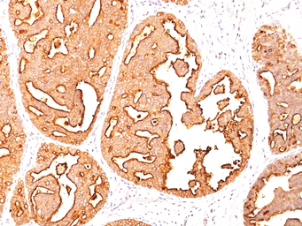 Anti-MUC1 antibody [MUC1/967] used in IHC (Paraffin sections) (IHC-P). GTX34854