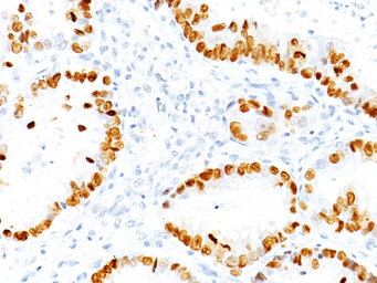Anti-NKX2.1 antibody [NX2.1/690] used in IHC (Paraffin sections) (IHC-P). GTX34906