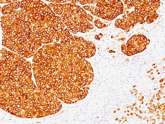 Anti-Tyrosinase antibody [SPM360] used in IHC (Paraffin sections) (IHC-P). GTX35152