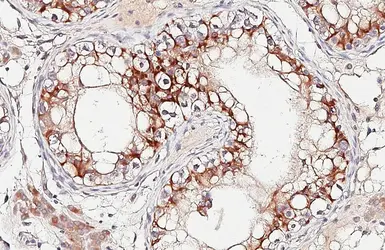 Anti-ALK antibody [HL6409] used in IHC (Paraffin sections) (IHC-P). GTX648854