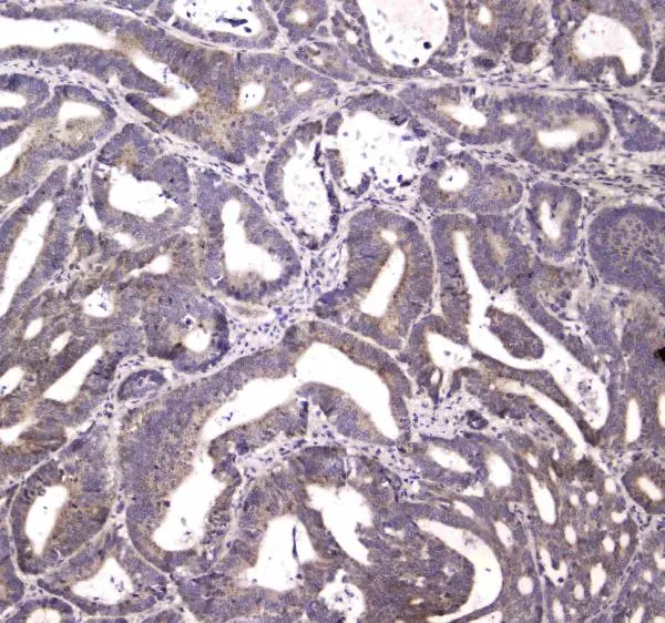 IHC-P analysis of human rectal cancer tissue using GTX00643 HtrA1 antibody.<br>Antigen retrieval : Heat mediated antigen retrieval was performed in citrate buffer (pH6, epitope retrieval solution) for 20 mins<br>Dilution : 1 ?g/ml