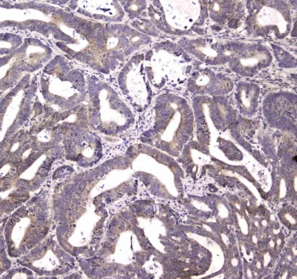 IHC-P analysis of human rectal cancer tissue using GTX00643 HtrA1 antibody. Antigen retrieval : Heat mediated antigen retrieval was performed in citrate buffer (pH6, epitope retrieval solution) for 20 mins Dilution : 1 microg/ml IHC-P analysis of human rectal cancer tissue using GTX00643 HtrA1 antibody. Antigen retrieval : Heat mediated antigen retrieval was performed in citrate buffer (pH6, epitope retrieval solution) for 20 mins Dilution : 1 microg/ml