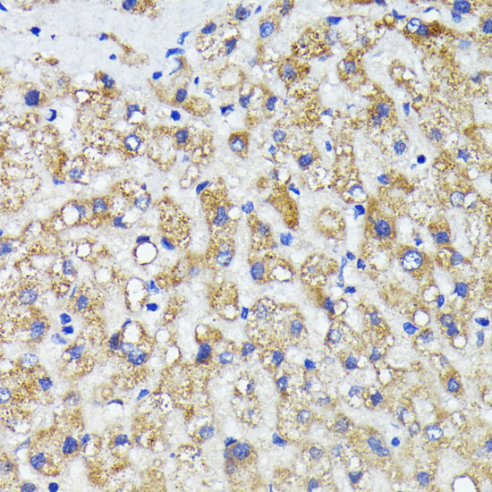 IHC-P analysis of human liver cancer tissue using GTX00661 AMOTL2 antibody.<br>Dilution : 1:200