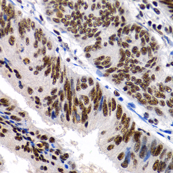 IHC-P analysis of human colon cancer tissue using GTX00789 MT2A antibody.<br>Dilution : 1:200