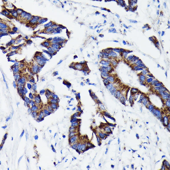 IHC-P analysis of hmuan colon carcinoma tissue section using GTX00797 Prohibitin antibody [GT1139]. Dlution : 1:100