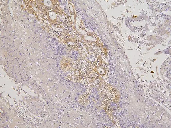 IHC-P analysis of human oesophagus squama cancer tissue using GTX00828 RBMS3 antibody. Antigen retrieval : Heat mediated antigen retrieval was performed in citrate buffer (pH6, epitope retrieval solution) for 20 mins Dilution : 1microg/mL