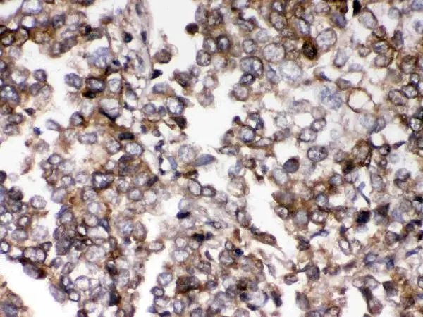 IHC-P analysis of human lung cancer tissue using GTX00830 AIM2 antibody.
