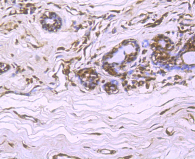 IHC-P analysis of human breast cancer tissue section using GTX01050 Cullin 4a antibody [JU07-33].