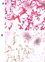 IHC-Fr analysis of human ovarian cancer tissue using GTX01069 UCHL5 antibody. Panel A : HE staining Panel B : IHC-Fr staining Dilution : 1:250 IHC-Fr analysis of human ovarian cancer tissue using GTX01069 UCHL5 antibody. Panel A : HE staining Panel B : IHC-Fr staining Dilution : 1:250