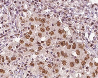IHC-P analysis of human liver tissue section using GTX01072 XRN2 Antibody. Antigen retrieval : Heat mediated antigen retrieval step in citrate buffer was performed Dilution : 1:100