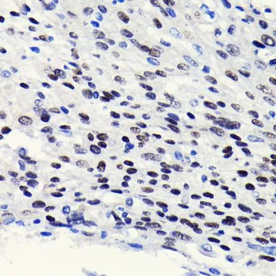 IHC-P analysis of human esophageal cancer tissue section using GTX01529 p63 antibody [GT1221].<br>Dilution : 1:100