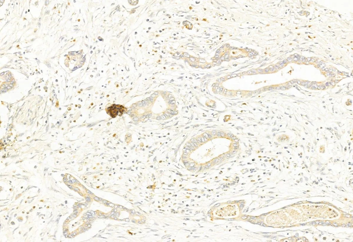 IHC-P analysis of human pancreatic cancer tissue using GTX01567 DRP1 (phospho Ser637) antibody. Antigen retireval : Heat mediated antigen retrieval step in citrate buffer Dilution : 1:100