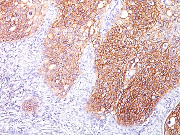 IHC-P analysis of human lung SqCC tissue using GTX01568 EGFR antibody [GFR/1667].