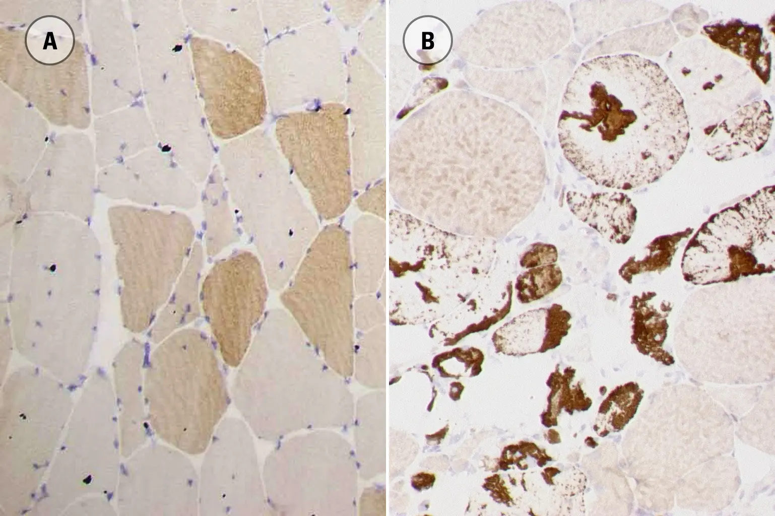 IHC-P analysis of human skeletal muscle tissue using GTX01881 Myotilin antibody [RSO34]. Note sarcoplasmic staining of normal muscle fibers (A) and presence of protein aggregates (B).