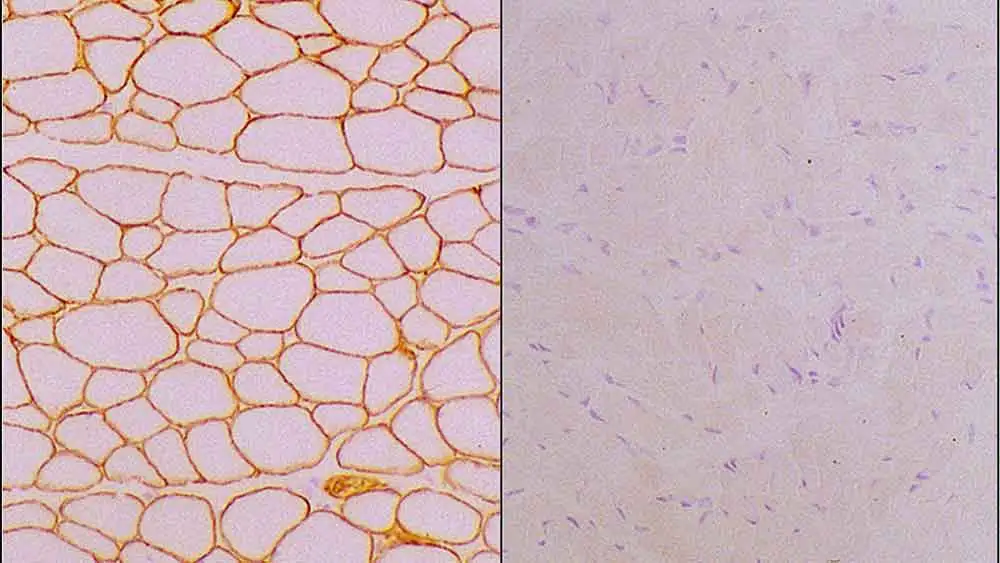 IHC-Fr analysis of human skeletal muscle tissue using GTX01902 Laminin alpha 2 antibody [Mer3/22B2]. Note membrane staining of normal muscle fibers (Left) and absence of staining of muscle fibers (Right).