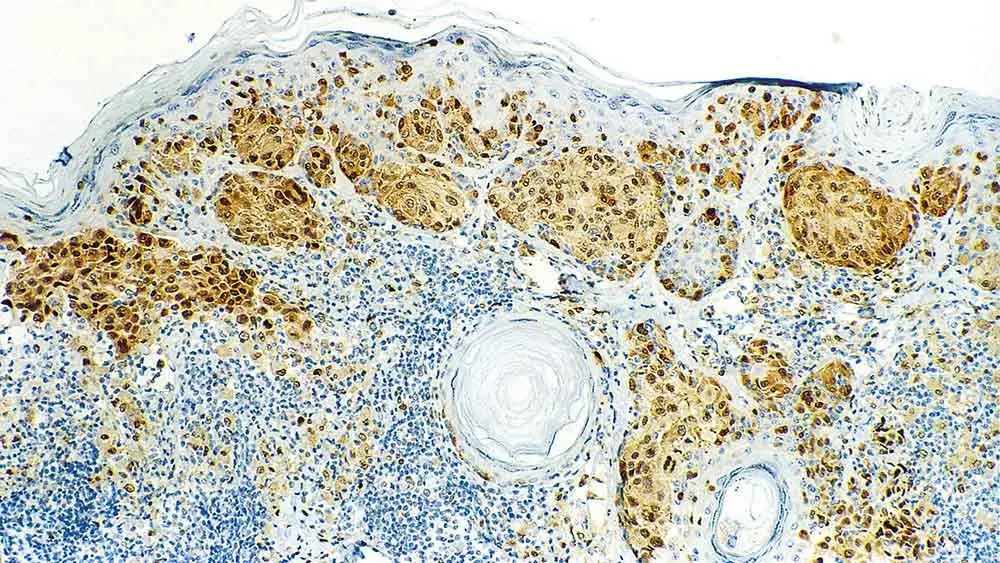 IHC-P analysis of human malignant melanoma tissue using GTX01904 MITF antibody [34CA5]. Note nuclear staining of melanoma cells.