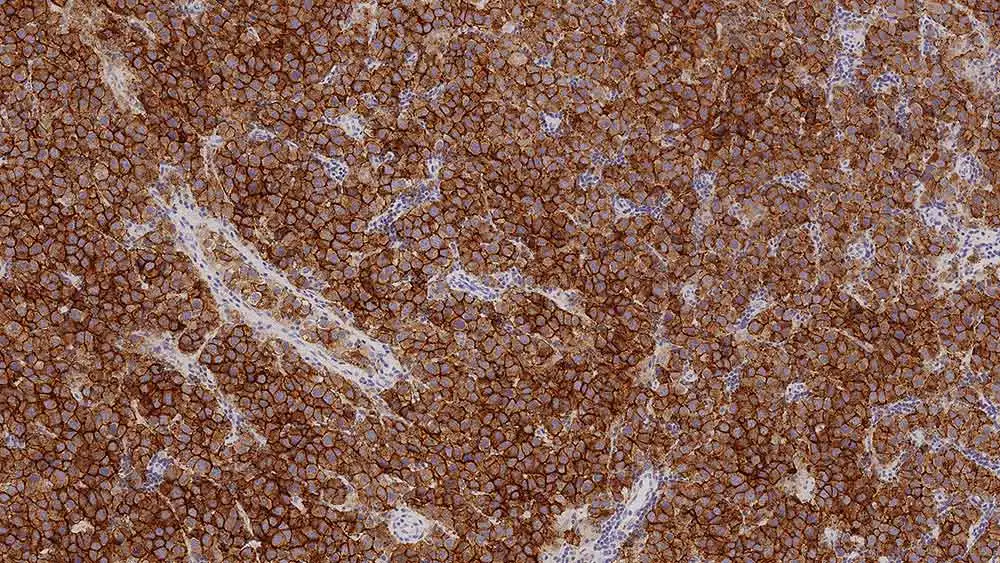 IHC-P analysis of human seminoma tissue using GTX01925 Placental Alkaline Phosphatase antibody [8A9]. Note the strong membrane and cytoplasmic staining of malignant cells.