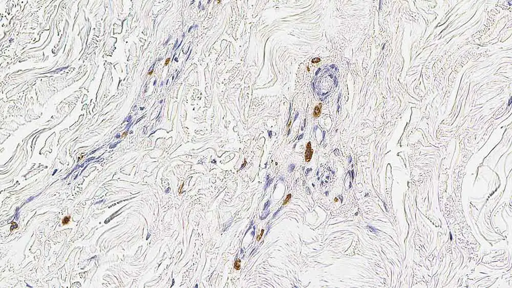 IHC-P analysis of human skin using GTX01964 Mast cell tryptase antibody [10D11]. Note cytoplasmic staining of mast cells.