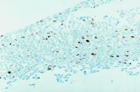 IHC-P analysis of HeLa cells using GTX01966 Aurora A antibody [JLM28]. Note nuclear staining of a proportion of cells.