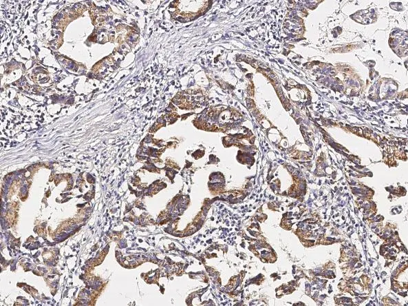 IHC-P analysis of human gastric cancer tissue section using GTX02035 PGA4 antibody [021].<br>Dilution : 1:1000