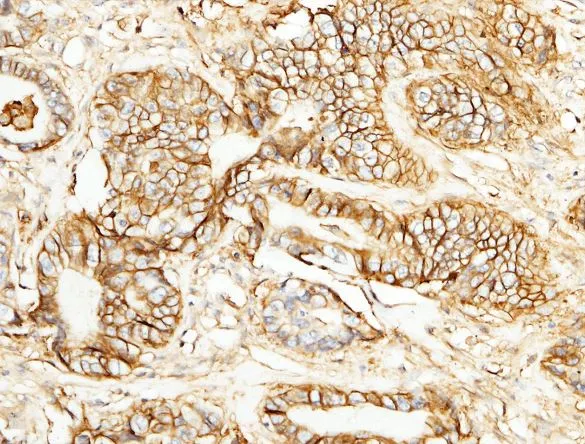 IHC-P analysis of human rectal cancer tissue section using GTX02108 CD147 antibody [125].<br>Dilution : 1:5000