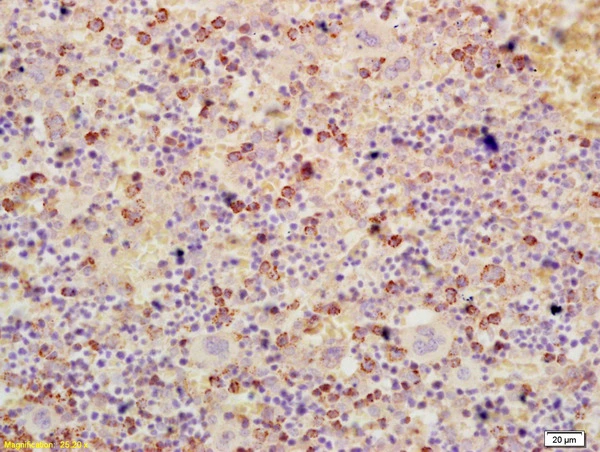 IHC-P analysis of human colon cancer tissue using GTX02578 ATF3 antibody. Dilution : 1:200 IHC-P analysis of human colon cancer tissue using GTX02578 ATF3 antibody. Dilution : 1:200