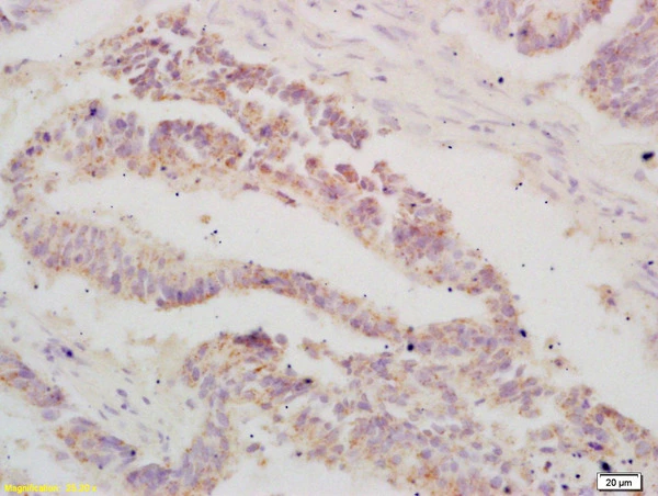 IHC-P analysis of human colon carcinoma tissue using GTX02578 ATF3 antibody. Dilution : 1:200