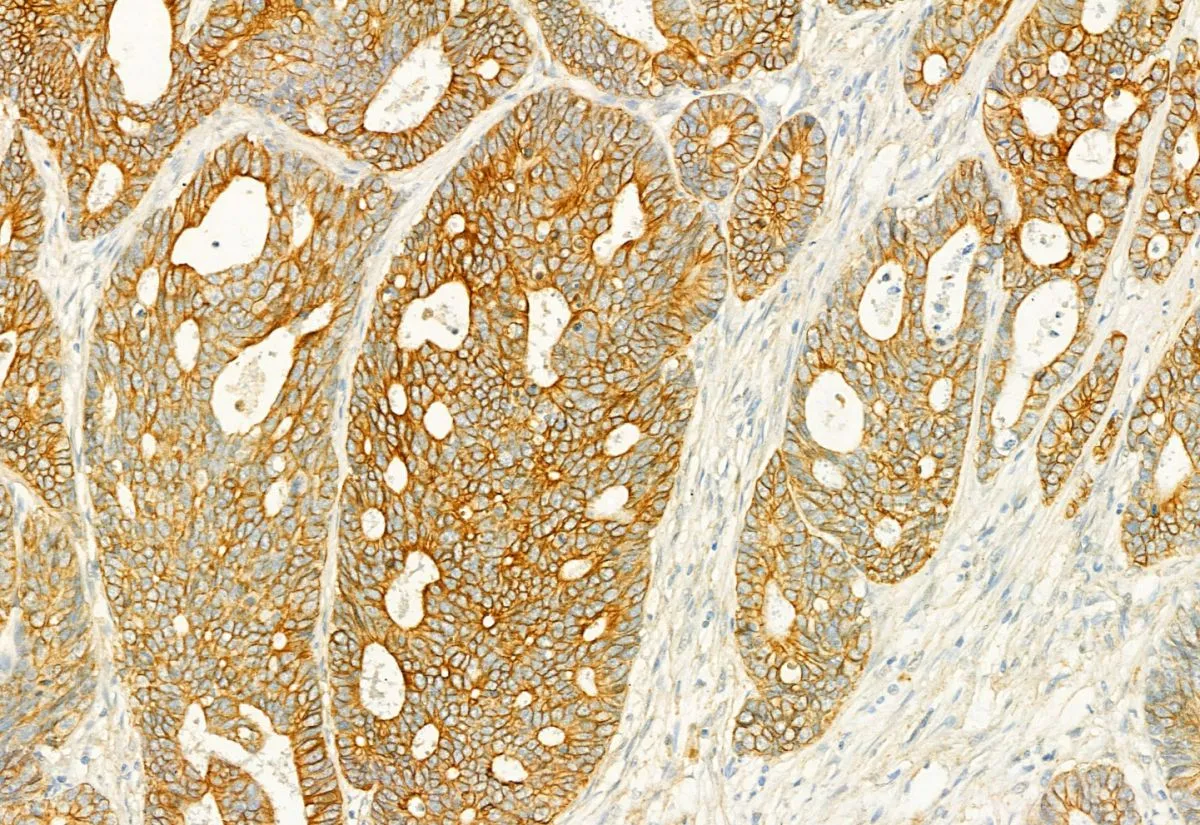 IHC-P analysis of human colorectal cancer tissue using GTX02580 PLCE1 antibody.<br>Antigen retireval : Heat mediated antigen retrieval step in citrate buffer was performed<br>Dilution : 1:100