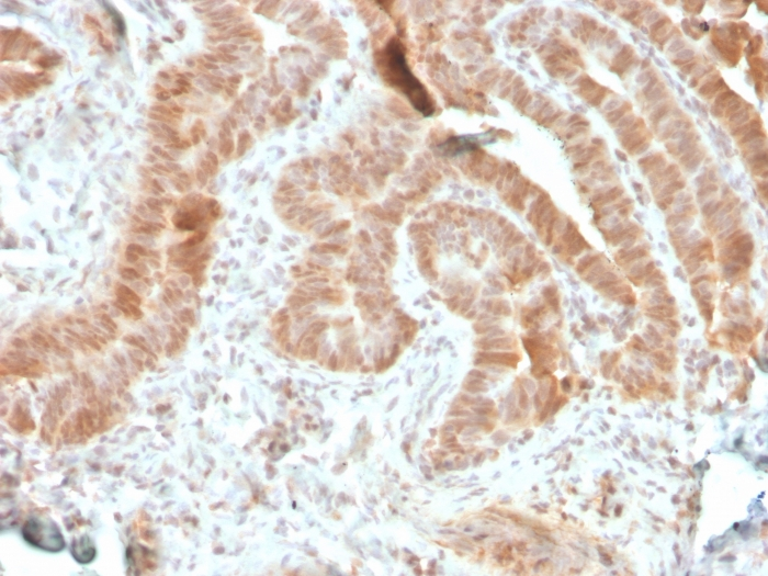 IHC-P analysis of human colon carcinoma section using GTX02583 AKT1 antibody [rAKT1/2491].