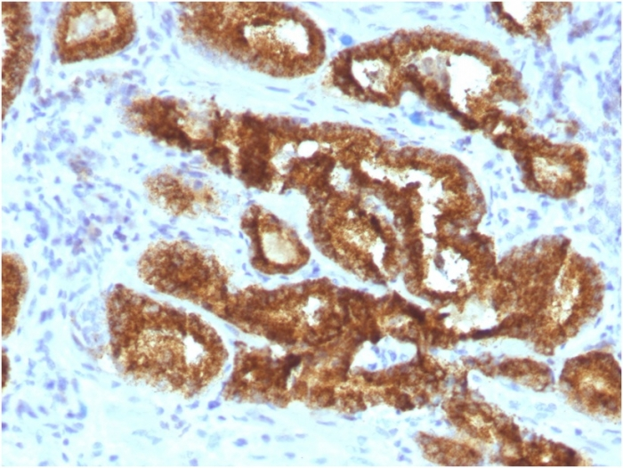 IHC-P analysis of human prostate carcinoma section using GTX02587 AMACR antibody [AMACR/3931R].