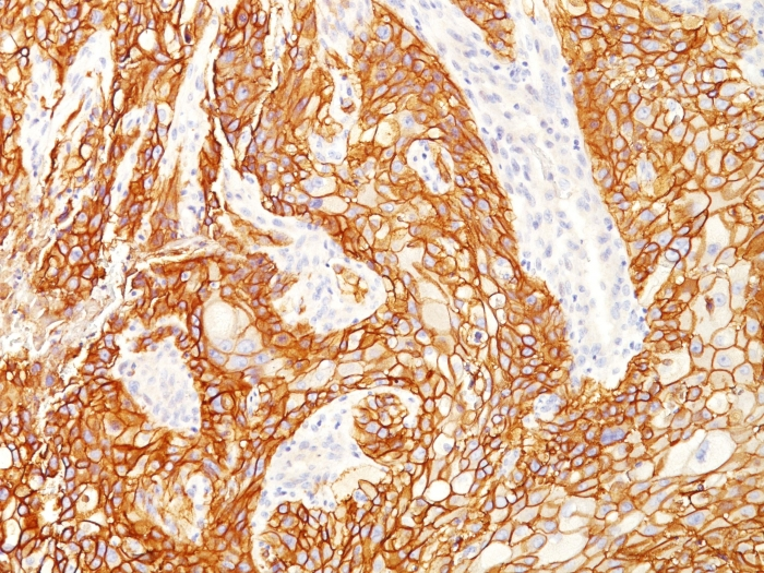 IHC-P analysis of human squamous cell carcinoma lung cancer section using GTX02628 EGFR antibody [GFR/2600R].