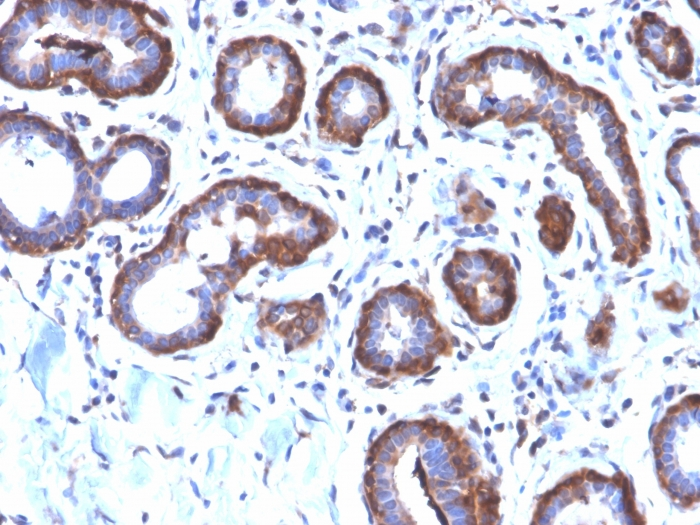 IHC-P analysis of human breast carcinoma section using GTX02641 Ferritin Light Chain antibody [FTL/2338R].