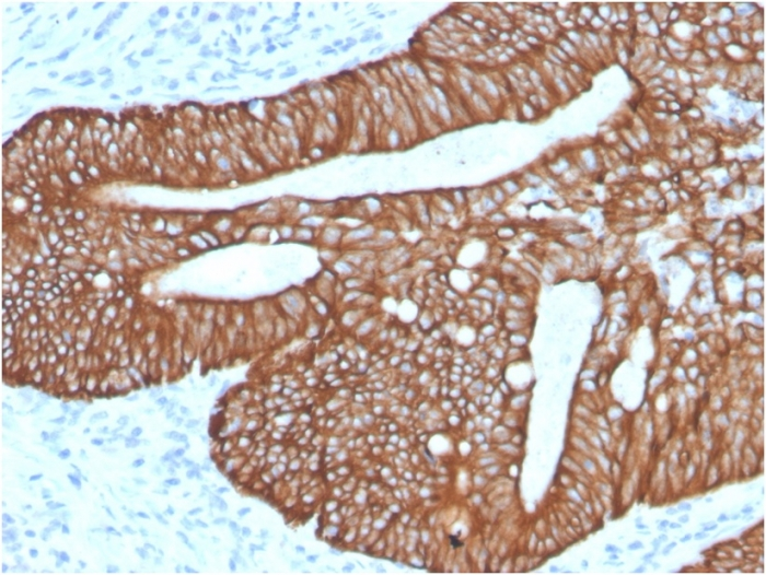 IHC-P analysis of human colon carcinoma section using GTX02658 Cytokeratin 18 antibody [KRT18/2819R].