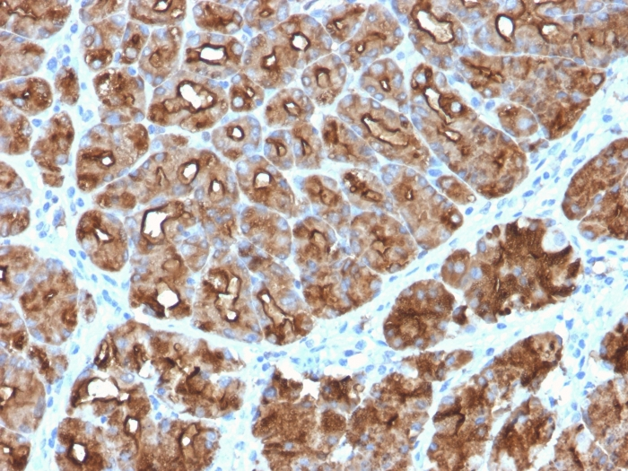 IHC-P analysis of human stomach carcinoma section using GTX02678 MUC1 antibody [MUC1/2818R].