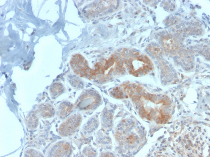IHC-P analysis of human breast carcinoma section using GTX02682 MVP/LRP antibody [VP2897R].