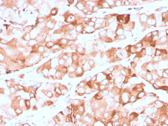 IHC-P analysis of human breast carcinoma section using GTX02693 Prolactin Receptor antibody [rPRLR/742].