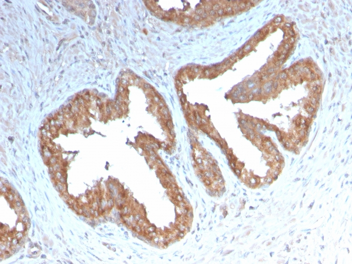 IHC-P analysis of human prostate carcinoma section using GTX02695 COX2 antibody [COX2/3232R].