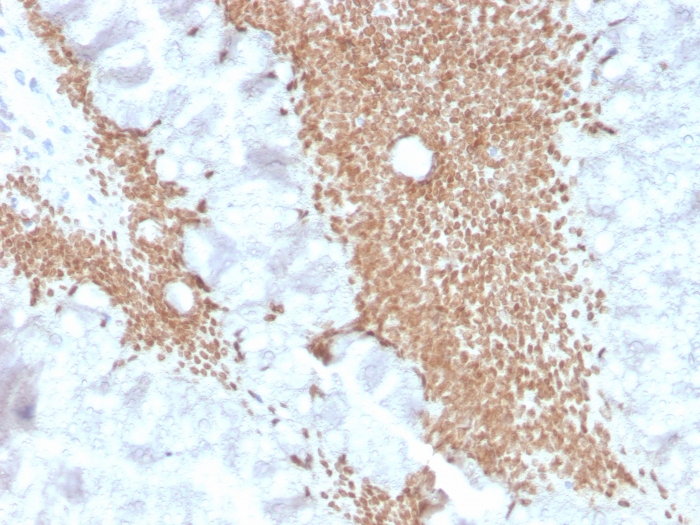 IHC-P analysis of human colon carcinoma section using GTX02705 SATB2 antibody [SATB2/4374R].