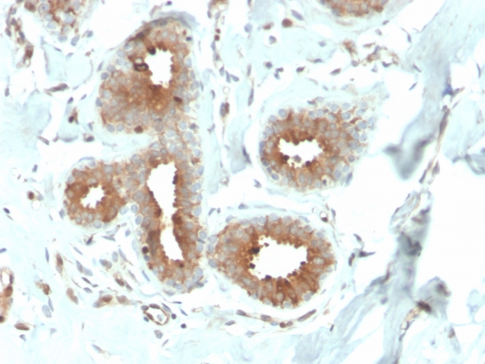 IHC-P analysis of human breast carcinoma section using GTX02706 Mammaglobin A antibody [MGB/4057R].