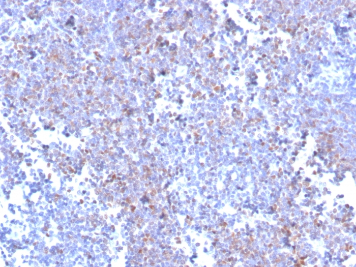 IHC-P analysis of human mantle cell lymphoma section using GTX02709 SOX11 antibody [SOX11/3235R].