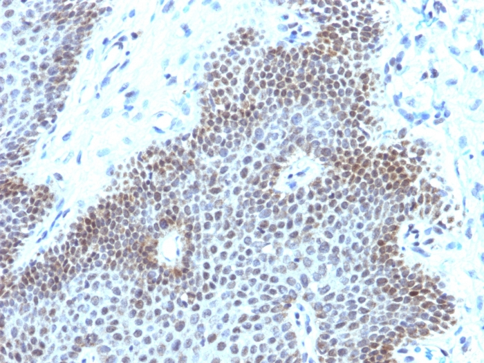 IHC-P analysis of human cervical carcinoma section using GTX02709 SOX11 antibody [SOX11/3235R].