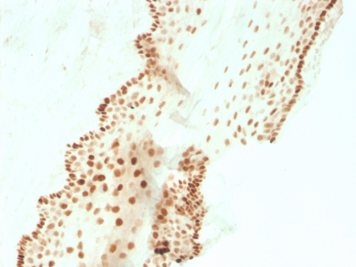 IHC-P analysis of human cervical carcinoma section using GTX02710 SOX2 antibody [SOX2/3811R].