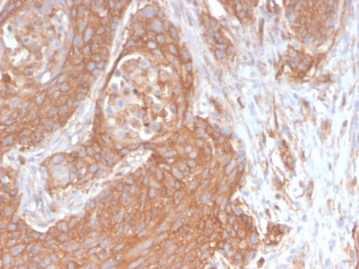IHC-P analysis of human pancreatic cancer section using GTX02716 SPTBN2 antibody [SPTBN2/2894R].