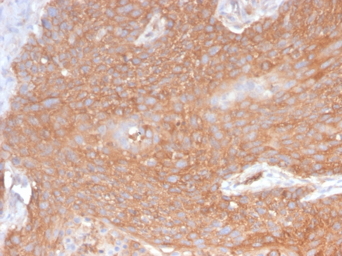 IHC-P analysis of human pancreatic cancer section using GTX02716 SPTBN2 antibody [SPTBN2/2894R].